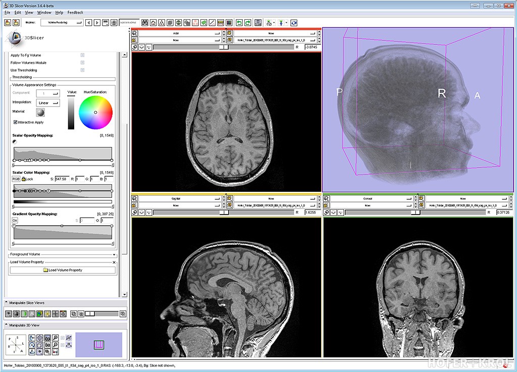 Slicer: Ein vielseitiges Tool für radiologische Daten